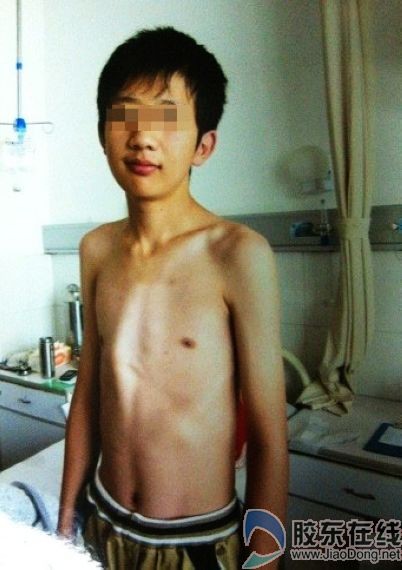 Cậu bé Xiao Li có xương ức giống gà và dáng đi như cụ già 60 tuổi